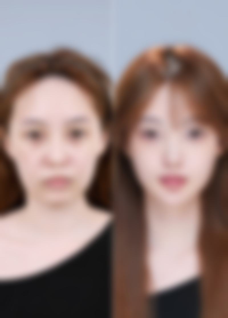 三、做完双眼皮手术眼角有增生的美学与护理建议