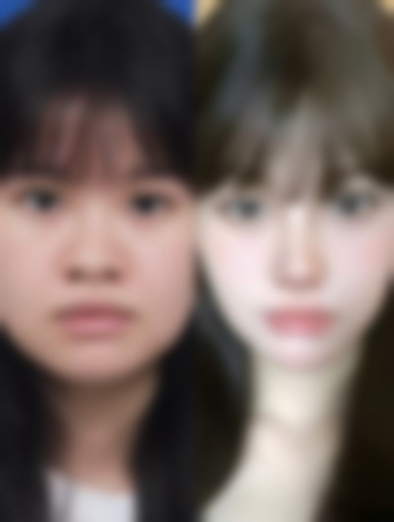 五、隆鼻后的注意事项