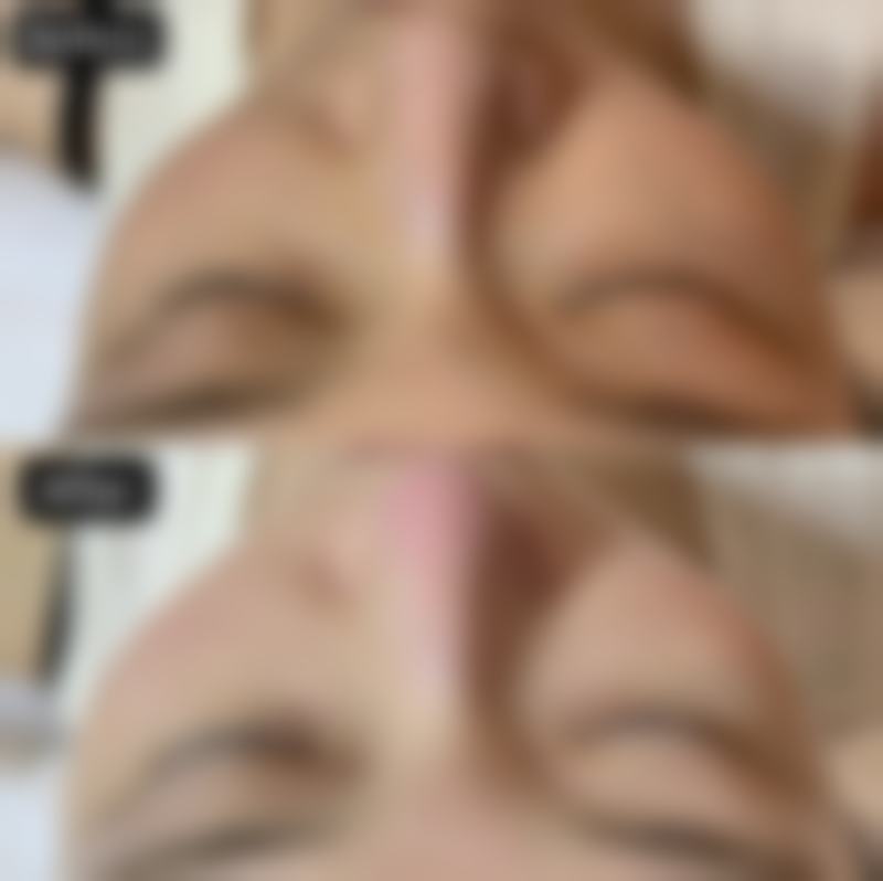 五、不同类型眼袋的解决方案总结