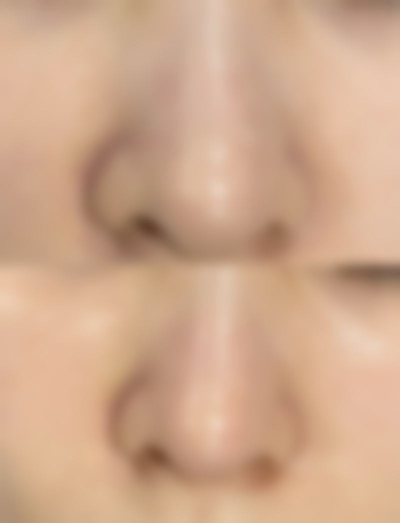 四、隆鼻后吸烟时间的建议