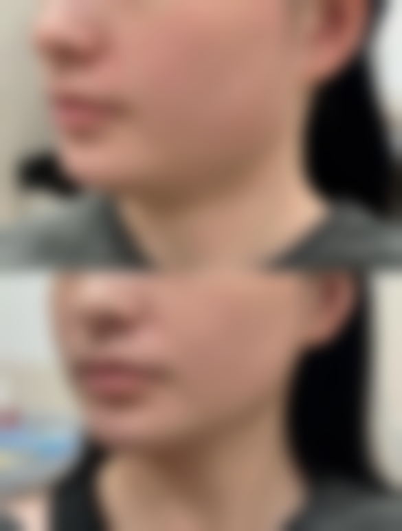 四、做双眼皮手术前之物品准备