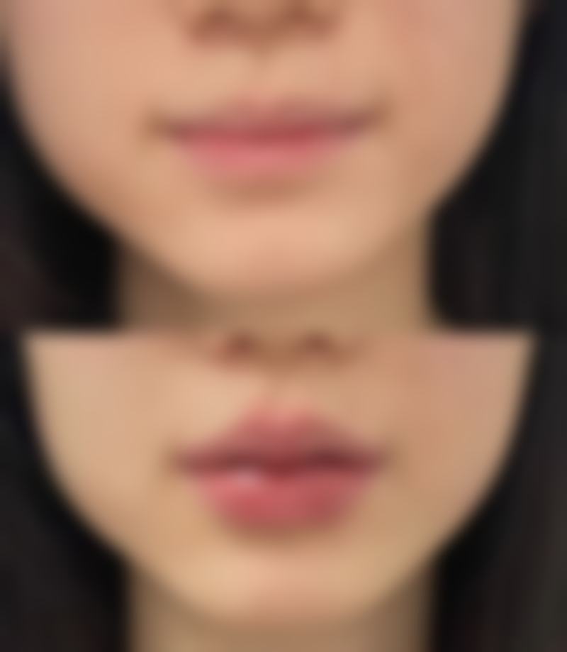 二、不同类型眼袋成因分析