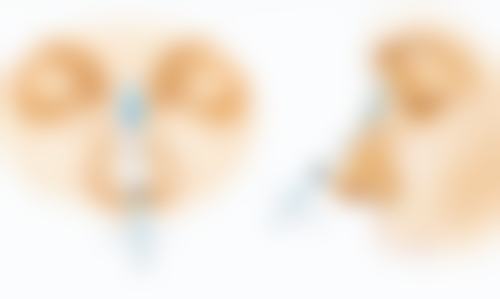 二、早期眼袋浮肿怎么消除之物理方法