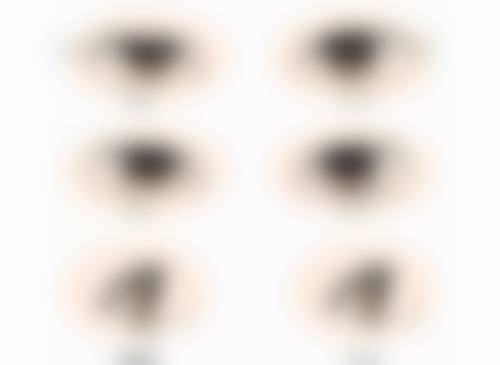 割完双眼皮有什么需要注意的？伤口护理、饮食禁忌、生活习惯调整全攻略！ 