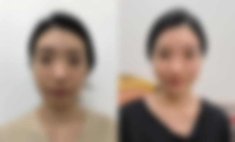 四、阴毛种植的风险和注意事项