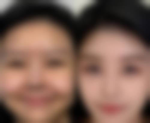 五、如何加快腿抽脂后走路不疼的修复