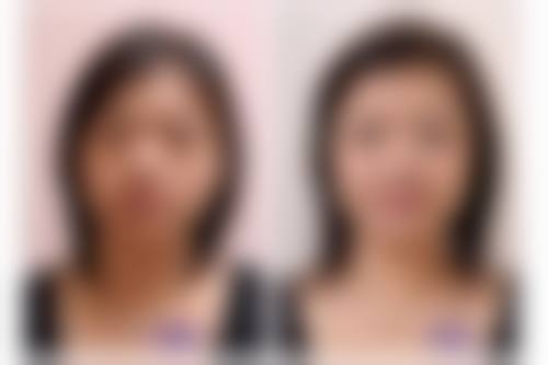 四、治疗周期及注意事项