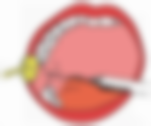 二、注射隆鼻后不同阶段能否捏鼻子