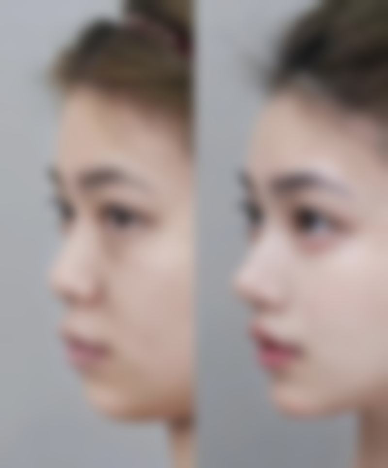 四、补打瘦脸针的风险提示与注意事项