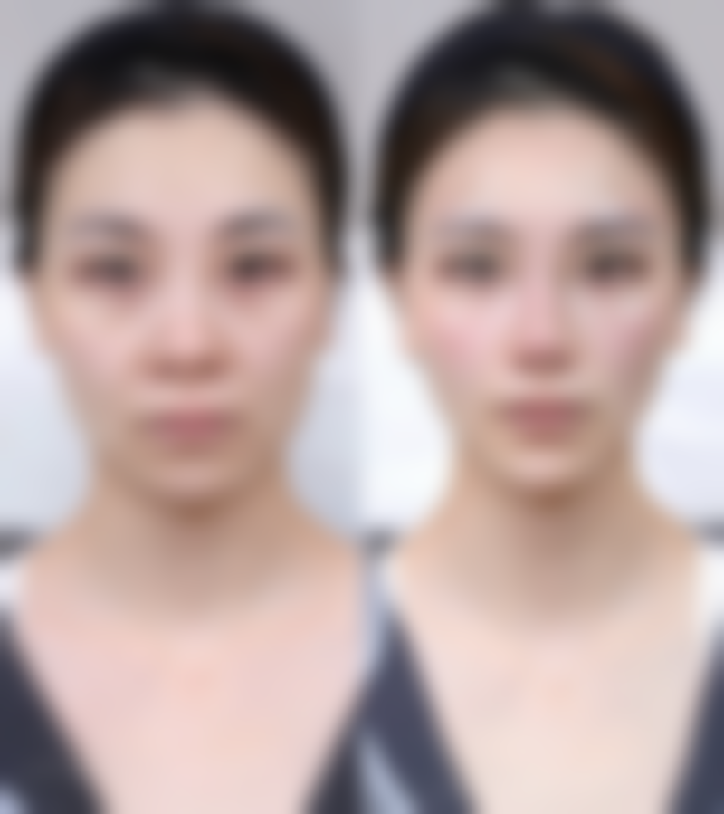 二、假体隆胸术后两侧间距过宽的原因及应对方案