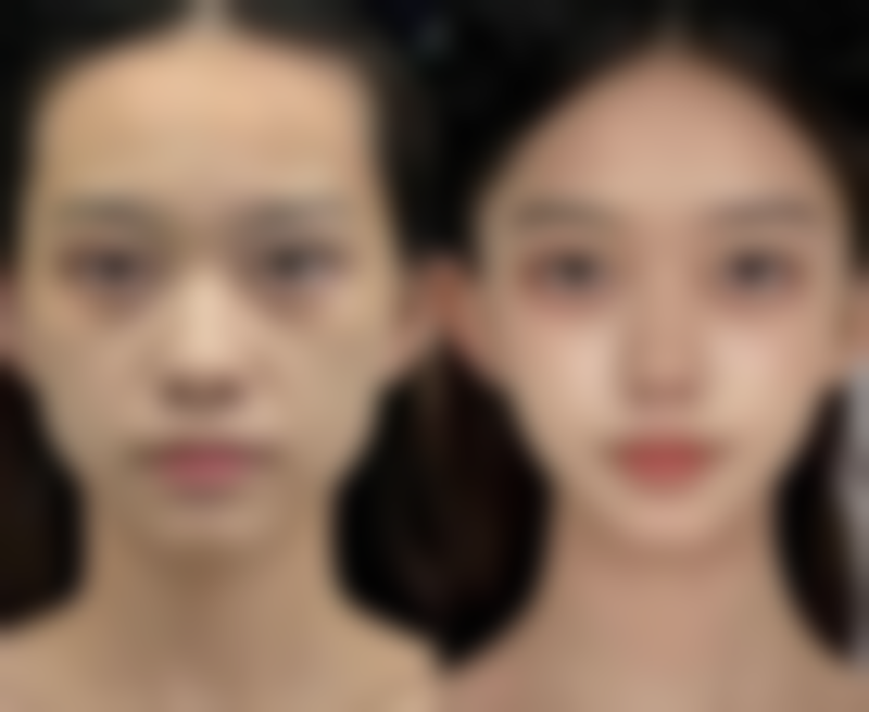 五、打瘦脸针后的护理要点