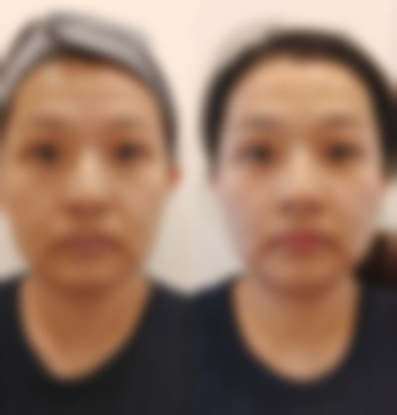 四、双眼皮会自己长出来吗之后天自然形成的几率分析