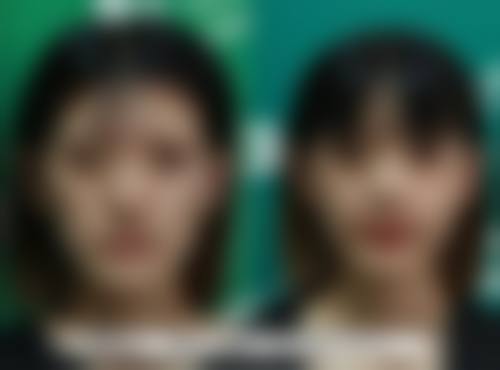 一、去完脸上的痣后留下疤痕：疤痕形成原因及类型分析