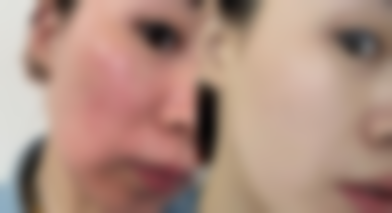 四、去完脸上的痣后留下疤痕：注意事项