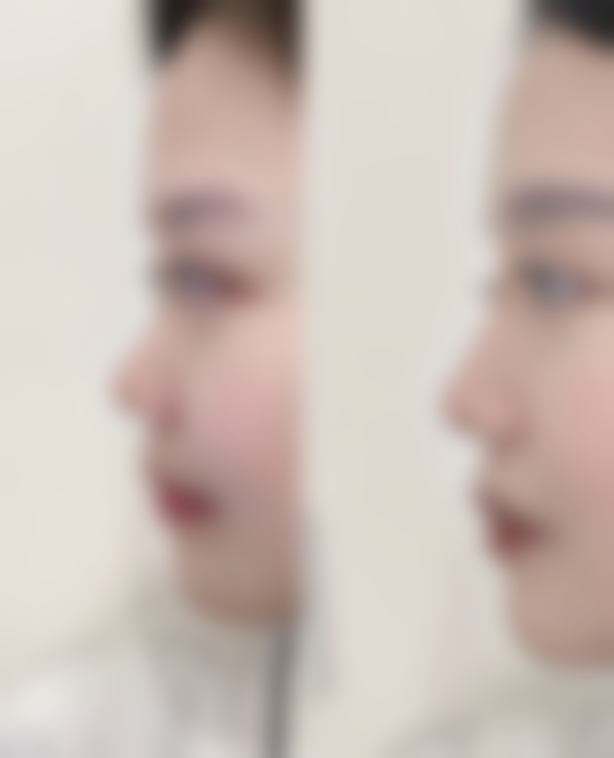 八、去除红色疤痕注意事项要牢记