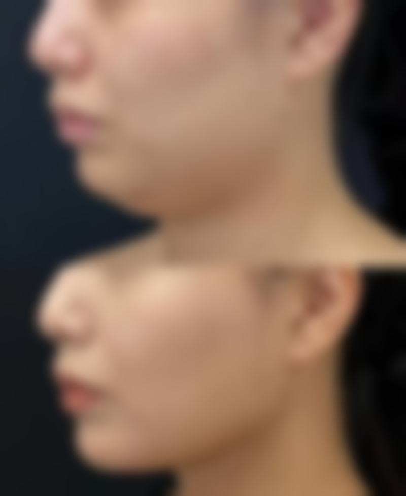 四、打瘦脸针怎么预约之特殊情况处理