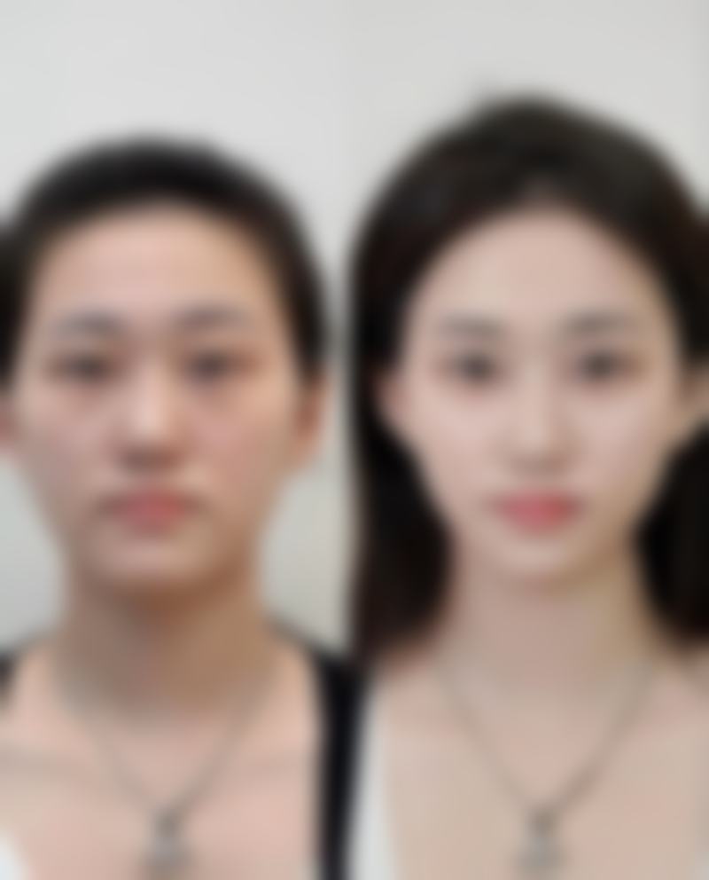 三、怎么样去面部凹陷疤痕之美学提示