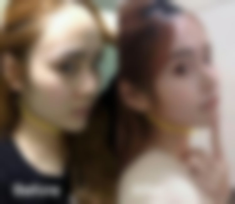 杭州连天美医疗美容医院濡白天使首支3774元，全脸填充隆鼻等效果佳 