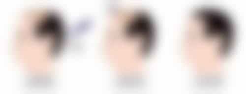 父母双眼皮会生出单眼皮孩子吗？解析遗传规律，揭秘生单眼皮宝宝的可能性