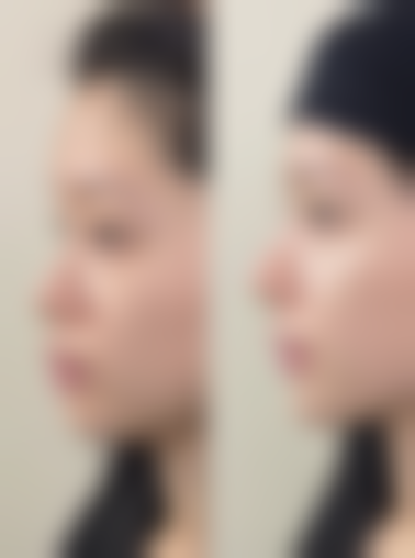 一、轻微下眼袋形成的原因