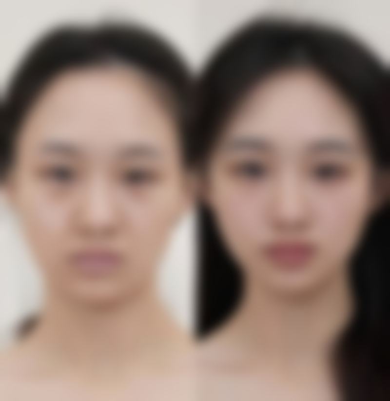 六、父母双眼皮会生出单眼皮孩子吗？总结与心态调整