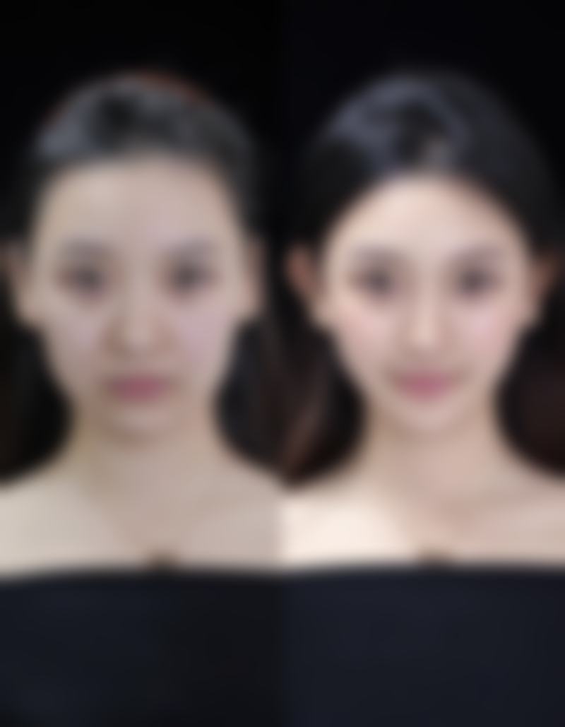 二、玻尿酸隆鼻