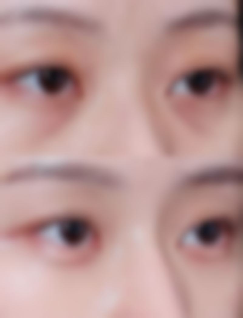 一、隆鼻手术的类型及特点