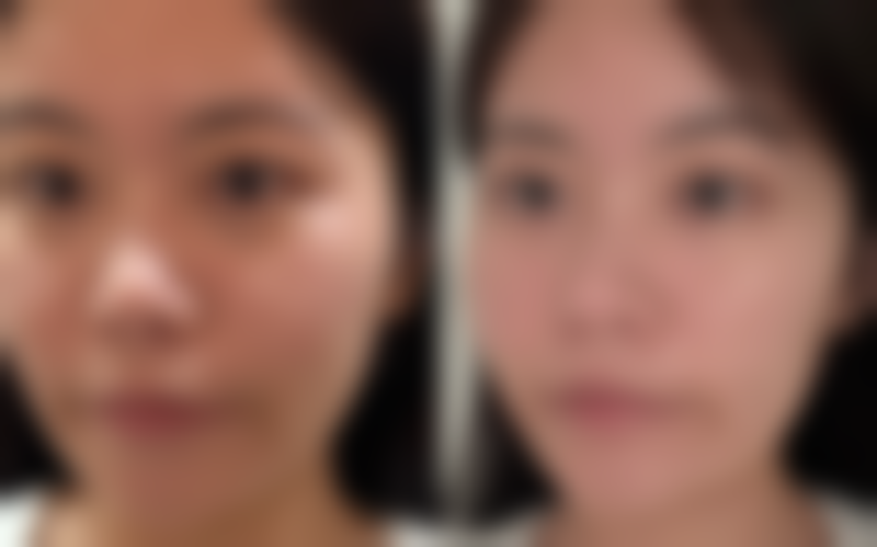 比较自然的隆鼻方式有哪些？玻尿酸、膨体、肋软骨等隆鼻种类解析