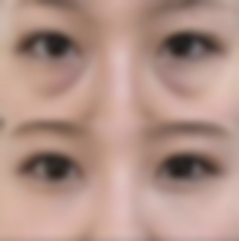 四、肋软骨隆鼻