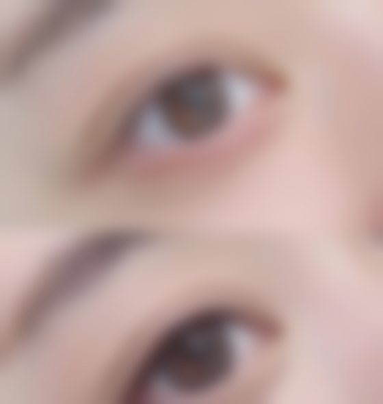 经常熬夜眼袋大怎么办？教你从日常护理到医美手段消除眼袋的实用方法