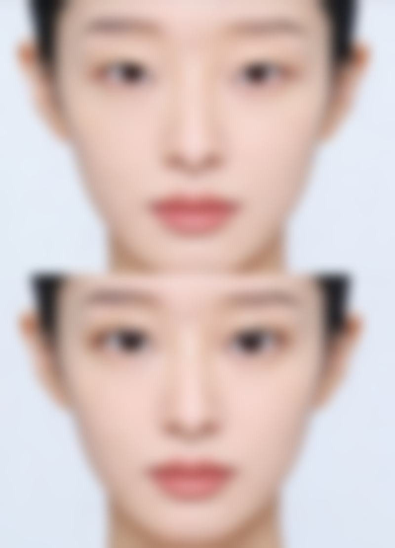 四、包皮环切术后钉子脱落的时间