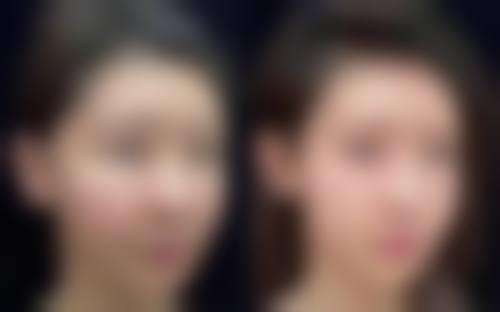 二、双眼皮术后多方面禁忌注意事项