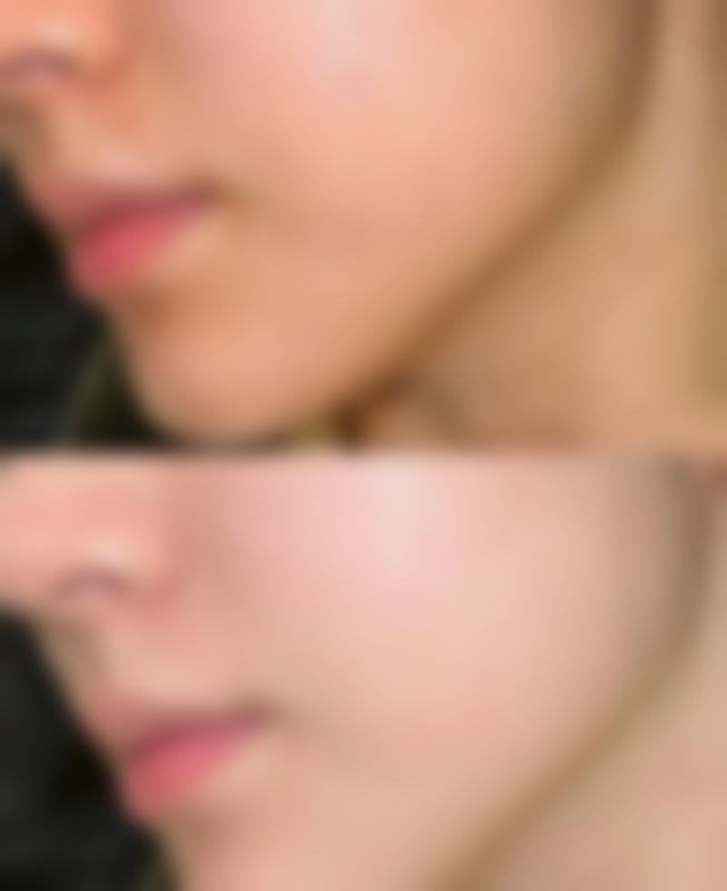 一、了解双眼皮拆线疼痛的正常情况