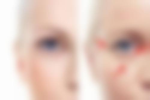 七、极射峰隆鼻的手术过程和术后护理