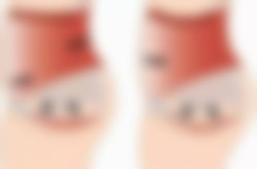 五、激光怎么如初眼袋之成效与维持