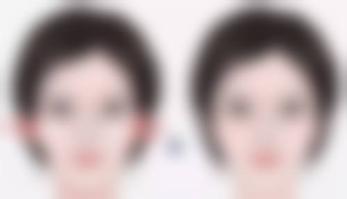 四、割双眼皮后遗症的修复方法