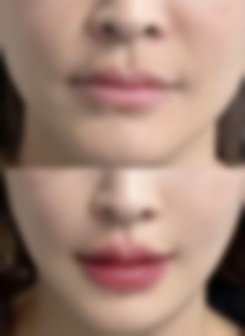 二、眼睛有眼袋黑眼圈的类型及对应解决方案