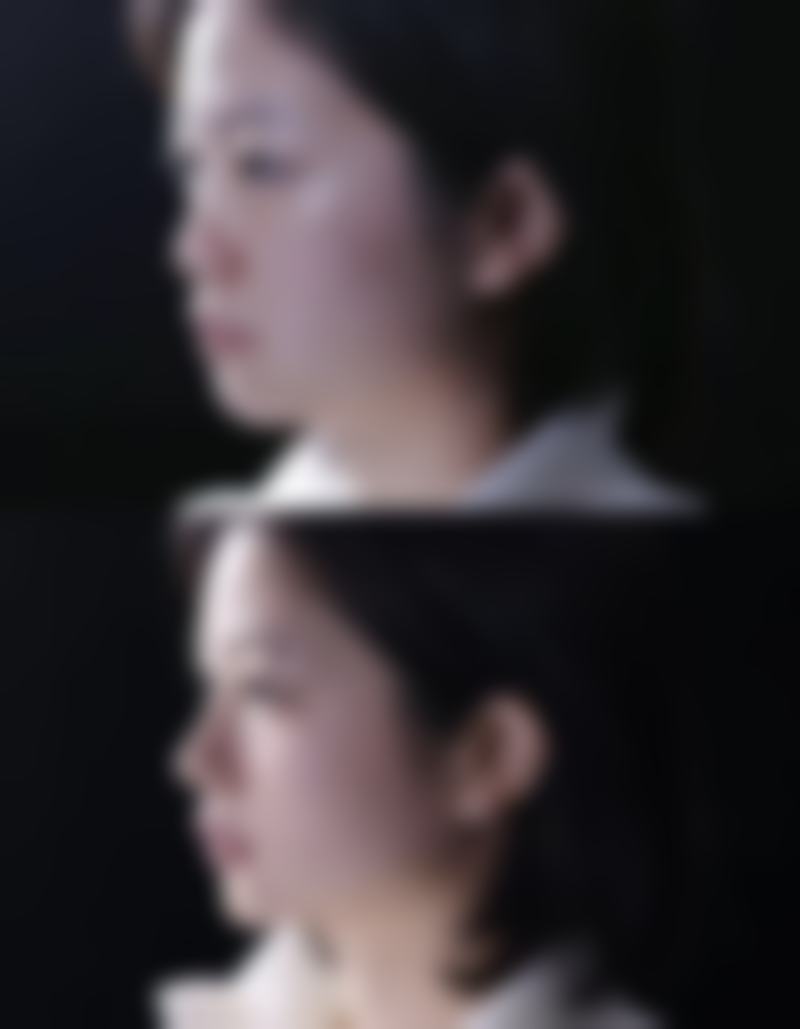 四、激光怎么如初眼袋之术后护理