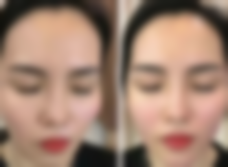 一、激光怎么如初眼袋之术前评估