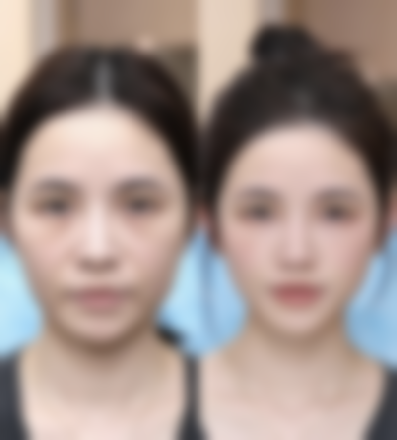 腰腹吸脂有什么危害和副作用？了解这些风险让你吸脂更安心！ 