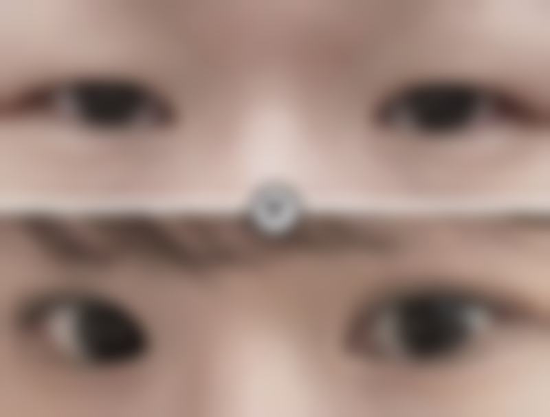 一、割双眼皮第二天能否上班与手术方式的关系