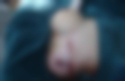 五、手术风险与注意事项