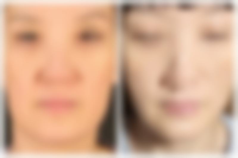 二、非手术改善方法