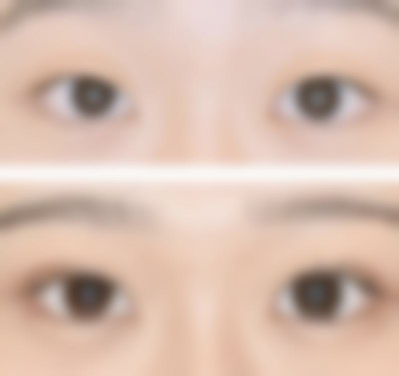 四、重度偏移或长期歪斜的手术修复方法