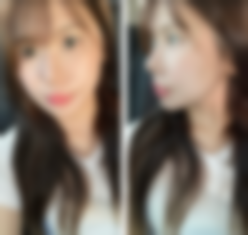 四、肋软骨隆鼻其他可能的后遗症