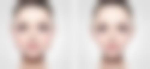 割眼袋内切多久恢复正常？1 - 3 周初步恢复，1 - 3 个月完全定型！ 