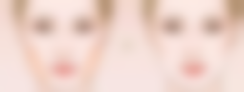 二、超体隆鼻修复的不同阶段