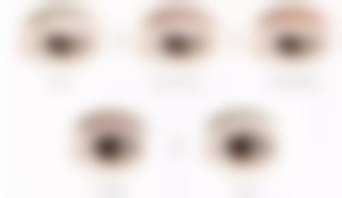 二、割眼袋内切修复各阶段情况