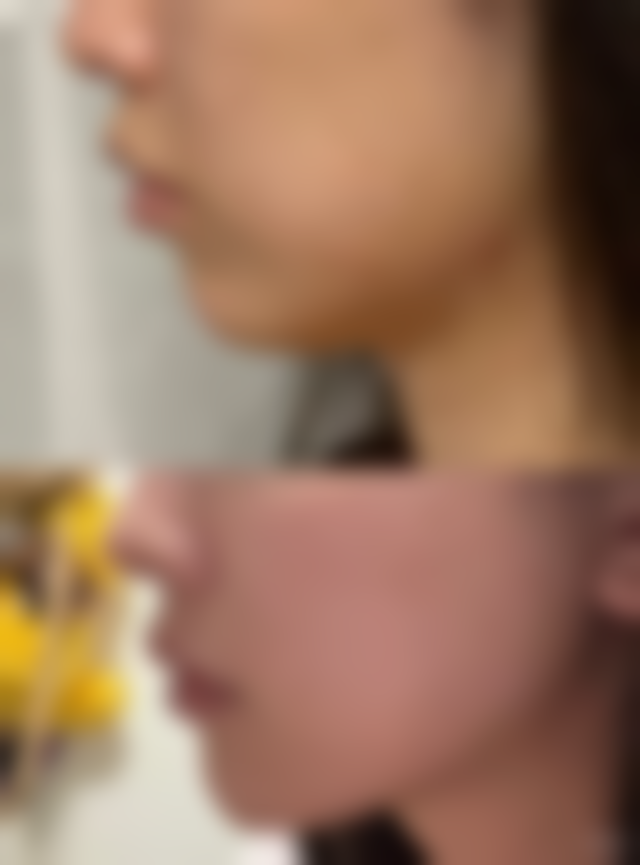 疤痕后皮肤变白有什么可以修复的吗？激光、磨削等方法助你恢复正常肤色 