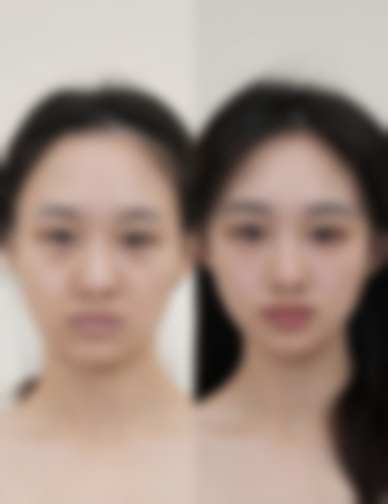 四、超体隆鼻修复期间的注意事项